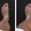 The Truth About Flat Feet: Can They Be Reversed?