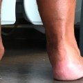 Rebuilding Arches in Flat Feet: An Expert's Perspective