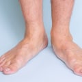 The Truth About Flat Feet: Can They Really Disappear?