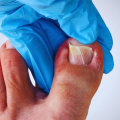 What Do Diabetic Toenails Look Like? Expert Advice for Those Dealing With Flat Feet and Diabetes