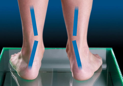 Understanding the Causes of Flat Feet