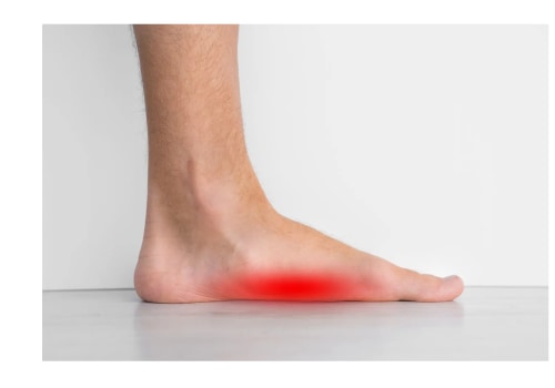 Understanding the Prevalence of Flat Feet