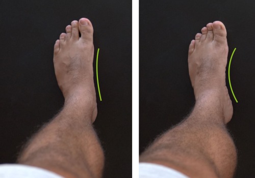 The Truth About Flat Feet: Can They Be Reversed?