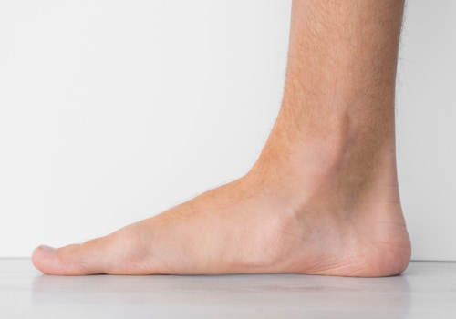 Understanding Flat Feet as a Military Disability