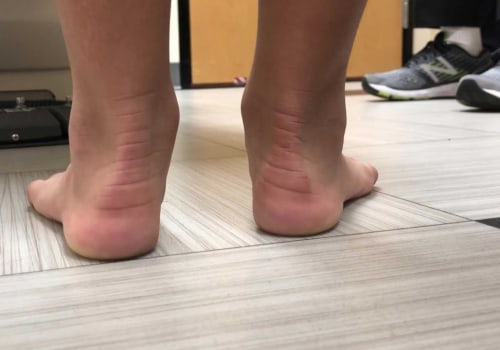 Understanding Flat Feet as a Disability