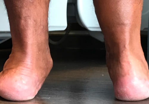 The Truth About Flat Feet: Can They Be Cured Permanently?