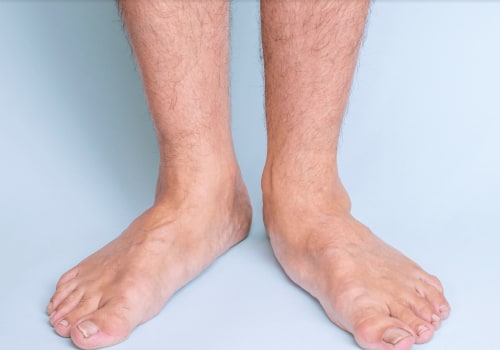 The Truth About Flat Feet: Do They Ever Go Away?