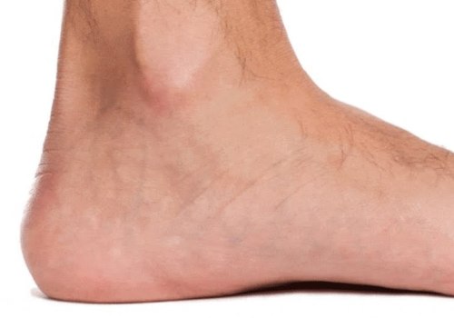 Debunking Myths and Understanding Disability Benefits for Flat Feet