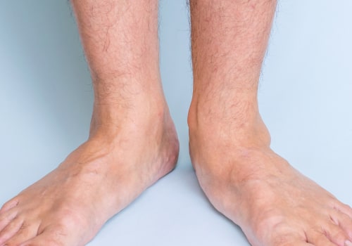 The Truth About Flat Feet: Can They Really Disappear?