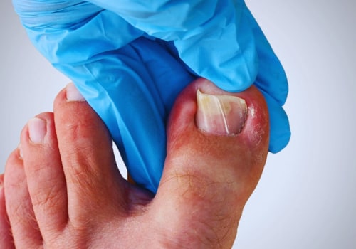 What Do Diabetic Toenails Look Like? Expert Advice for Those Dealing With Flat Feet and Diabetes